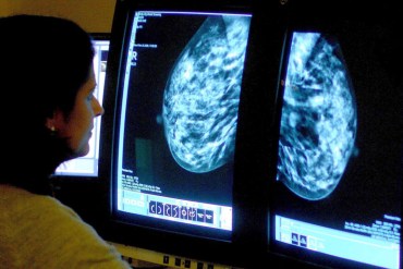 A consultant analyzes a mammogram in this file photo. (Photo by Rui Vieira/PA Wire for AP)