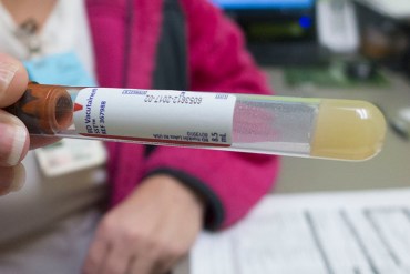 A nurse holds a vial with a camouflaged stopper that is used to collect blood specimens from newborns whose mothers were infected with Zika during their pregnancy at HIMA San Pablo Hospital in Caguas, Puerto Rico in November 2016. (Carmen Heredia Rodriguez/KHN)