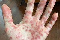 The palm of a hand and fingers is covered in red spots.