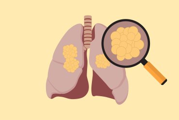 An illustration shows a diagram of lungs with a magnifying glass over cancer cells inside of them.