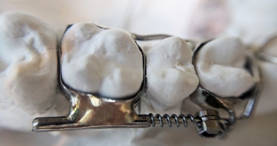 A photo of the AGGA device on a mold of teeth.