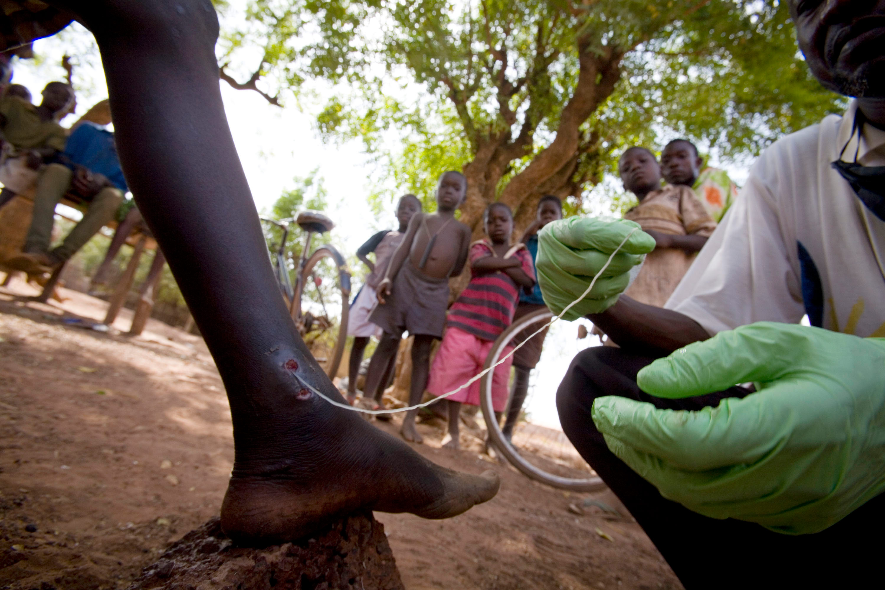 A photo of a Guinea worm being pulled from a child's leg.