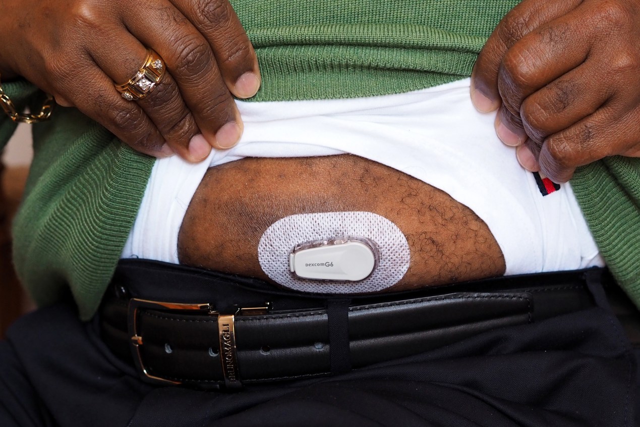 A photo of a man wearing a continuous glucose monitor on his stomach.