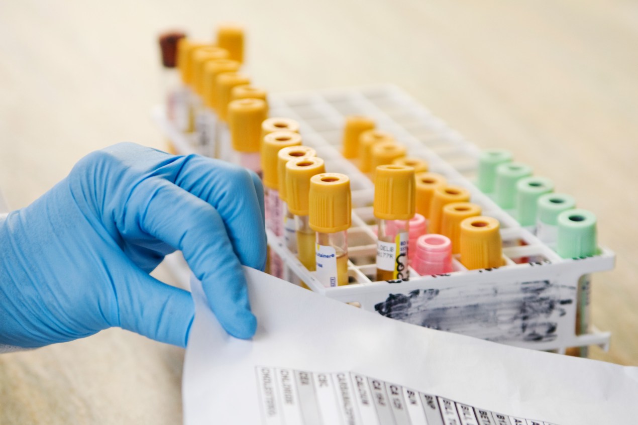 A photo of a gloved hand looking at medical test results next to vials of blood samples.