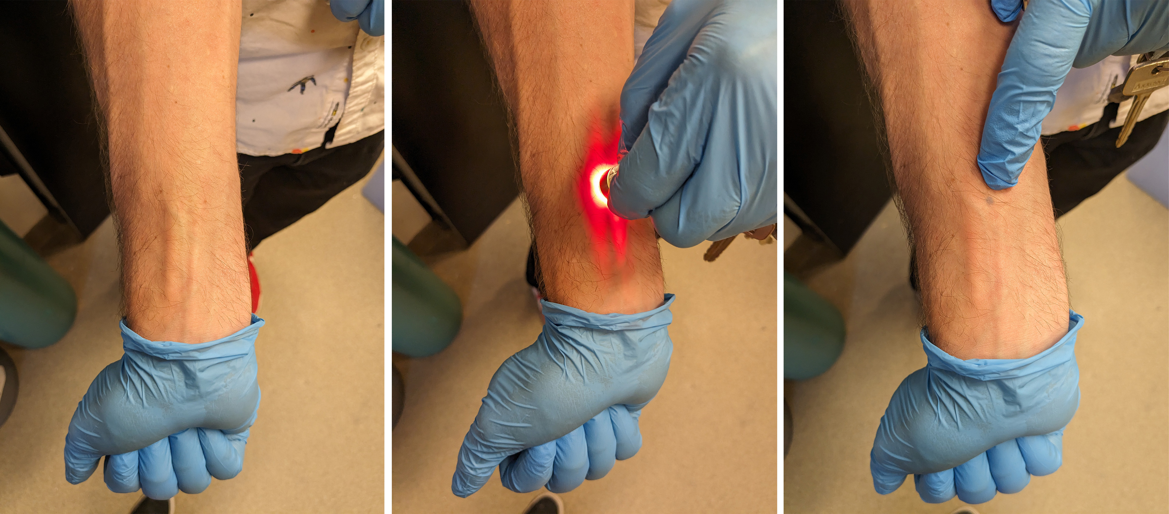 Three photos shown side-by-side: An arm with no tattoo; shining a UV light on their arm; their arm with a visible blue dot tattoo.