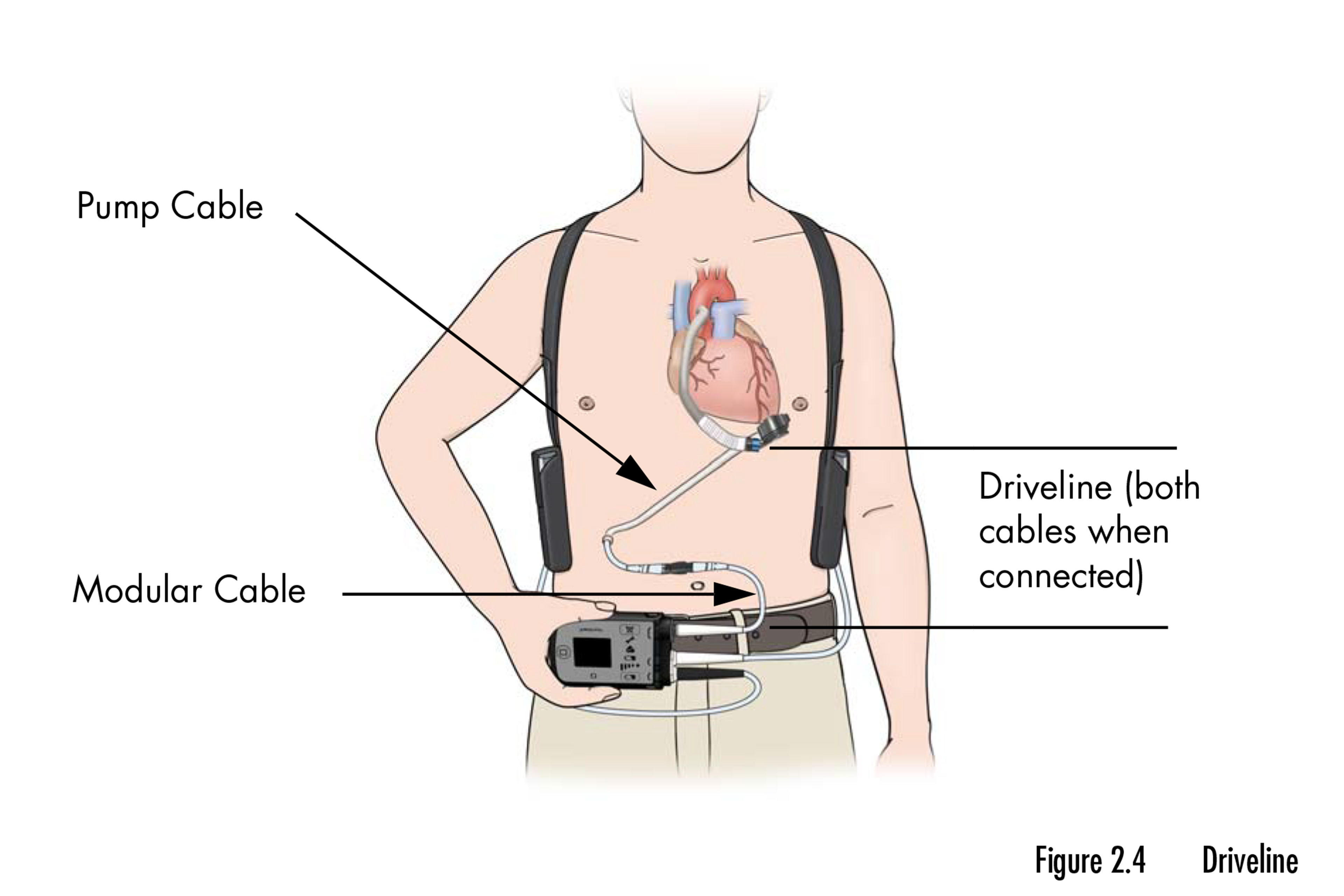 Patients Facing Death Are Opting for a Lifesaving Heart Device — But at ...