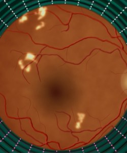 A rendering of a retina with white spots on it.