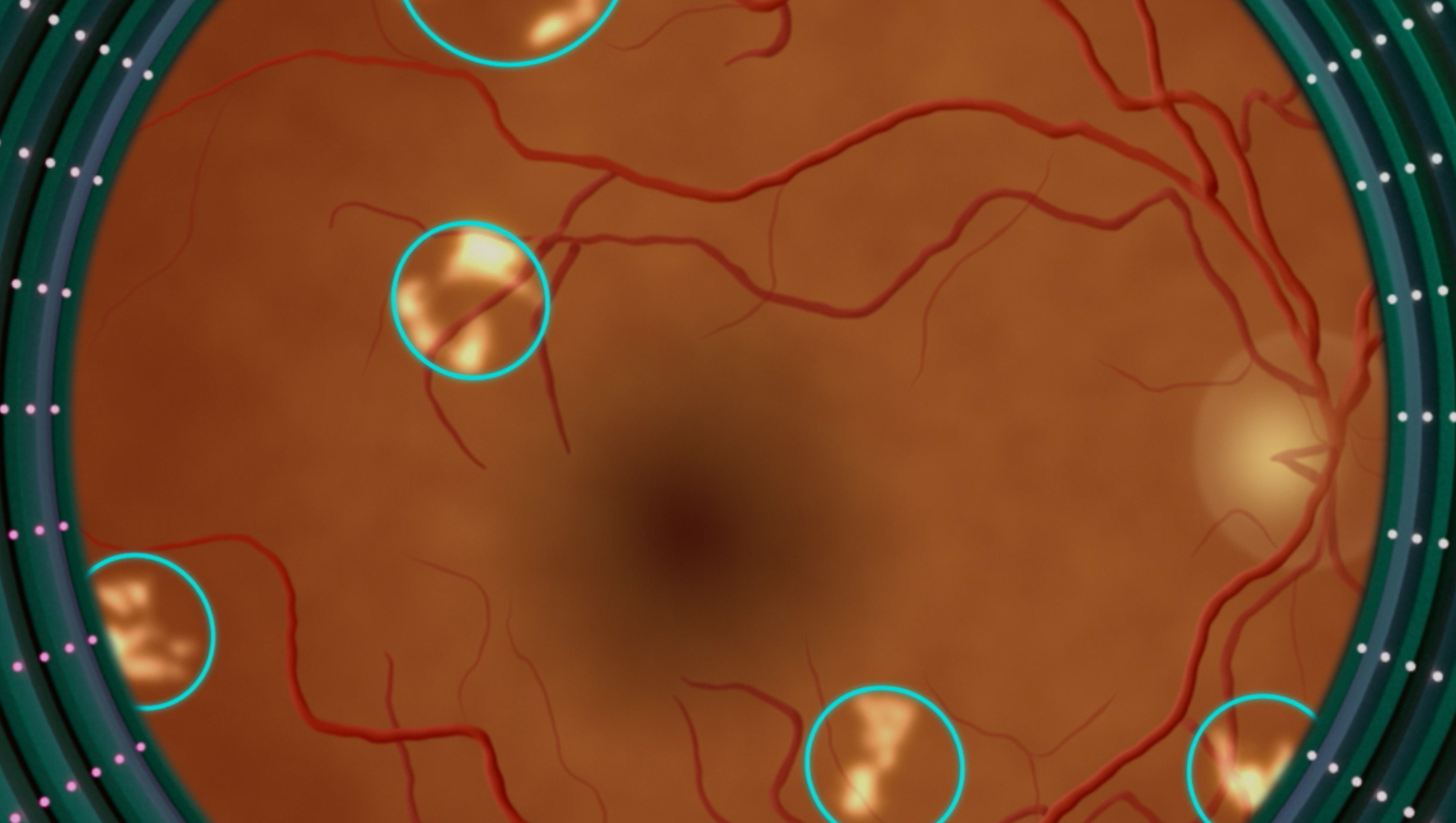 A close-up image of a retina with white spots circled.