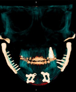 A scan of a person's skull with jaw impants highlighted.