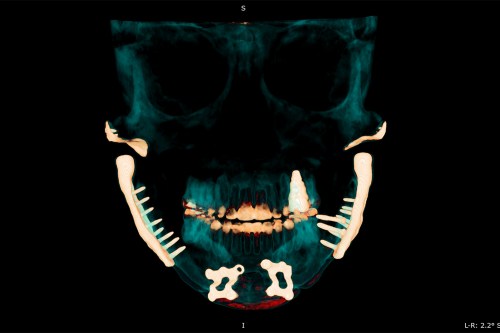 A scan of a person's skull with jaw impants highlighted.