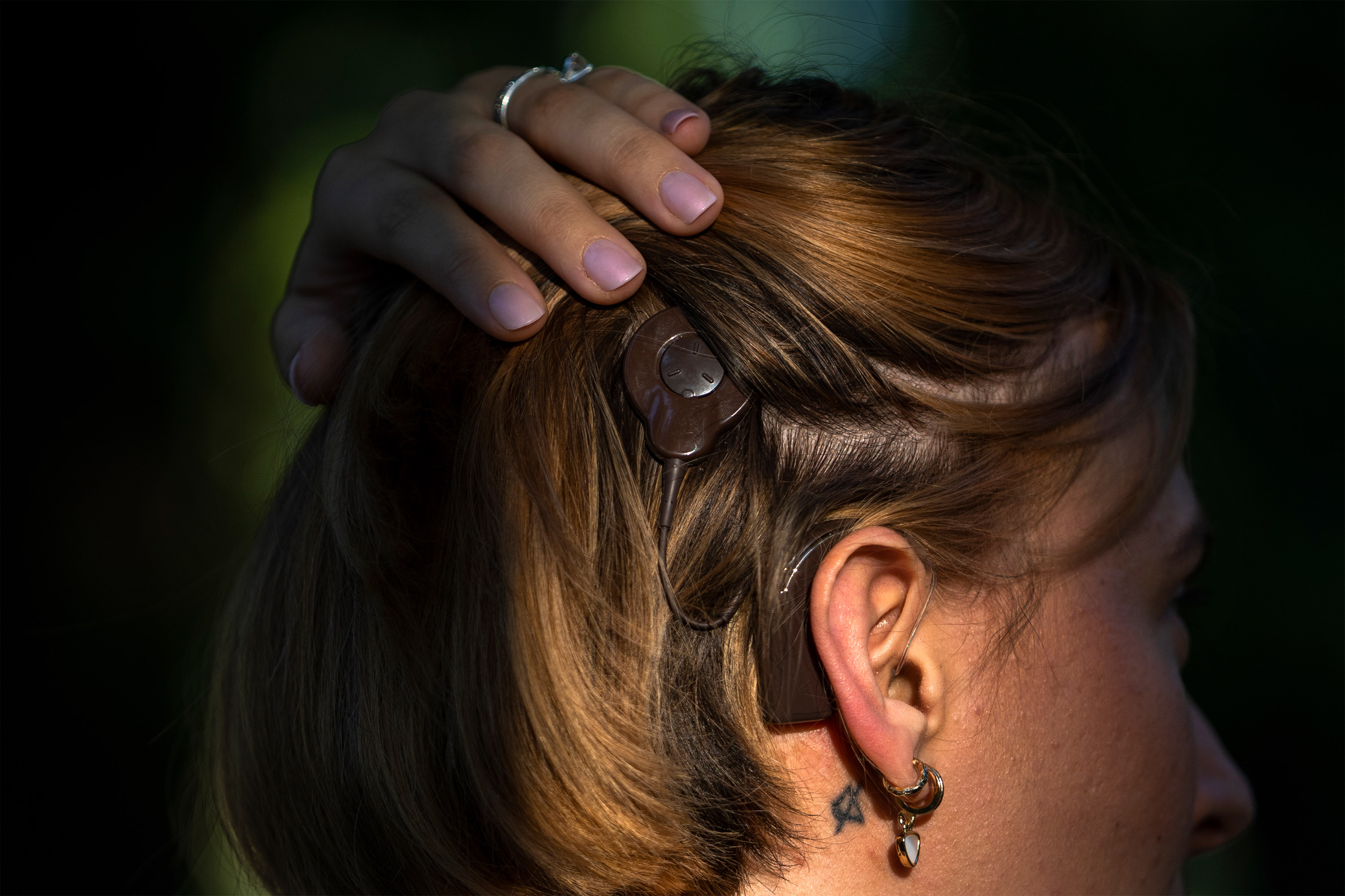 A photo of the back of Mai's heading, showing her hearing device implant.