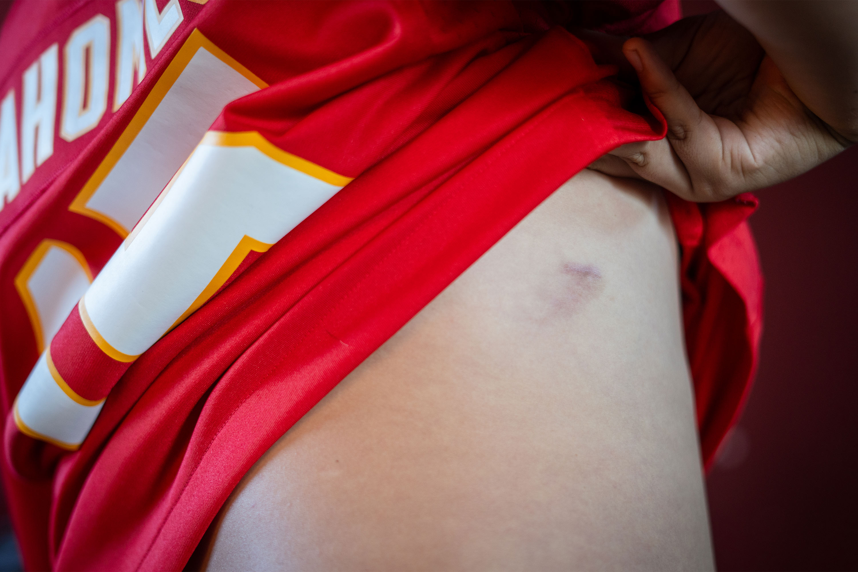 A photo of a healed bullet wound on Samuel Arellano's side.