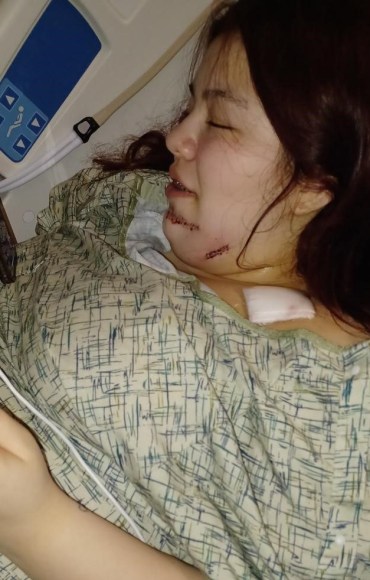 An up-close photo of a girl in a hospital bed, showing injuries to her jaw.