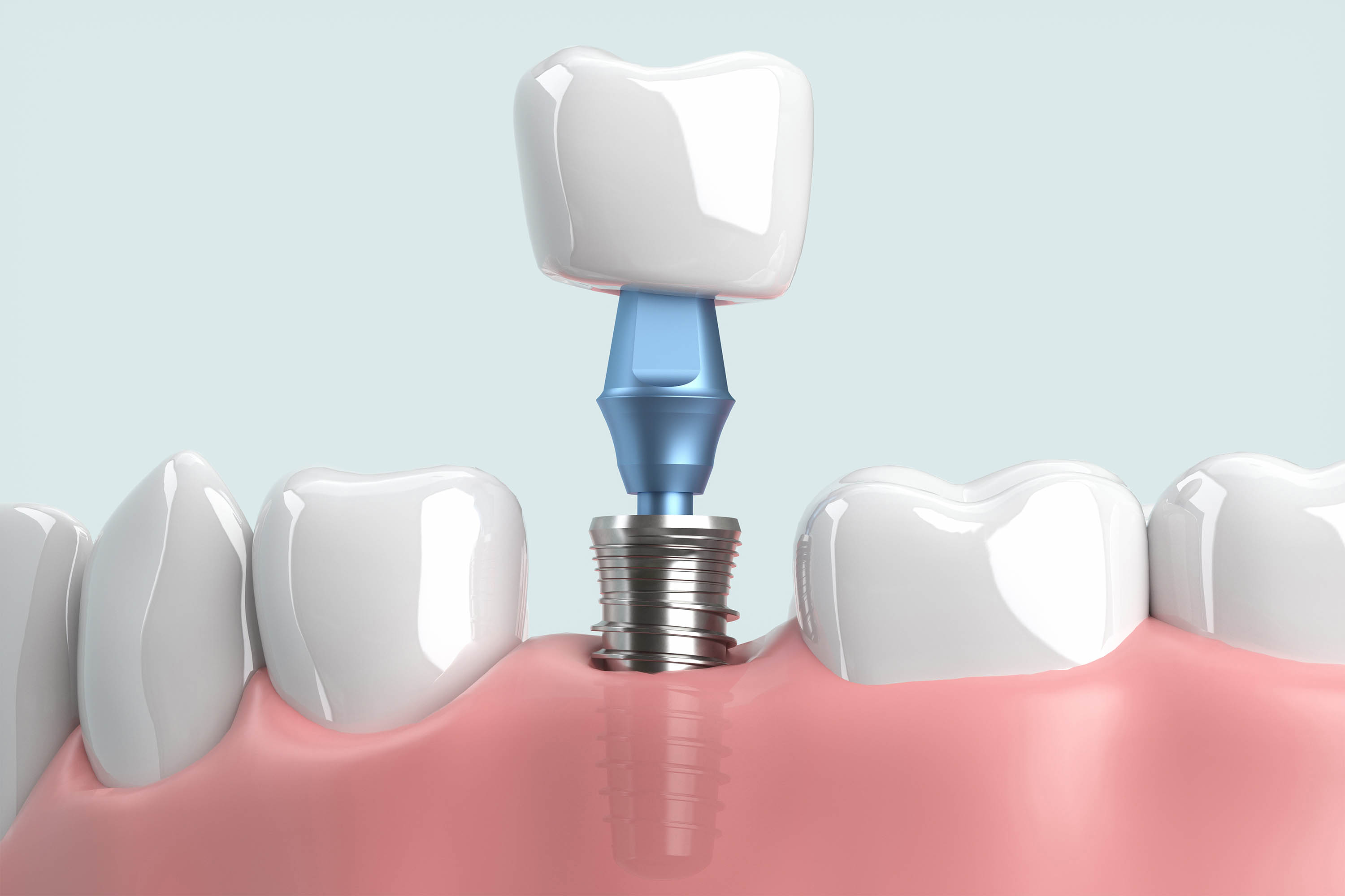 A digital depiction of a dental implant being inserted.