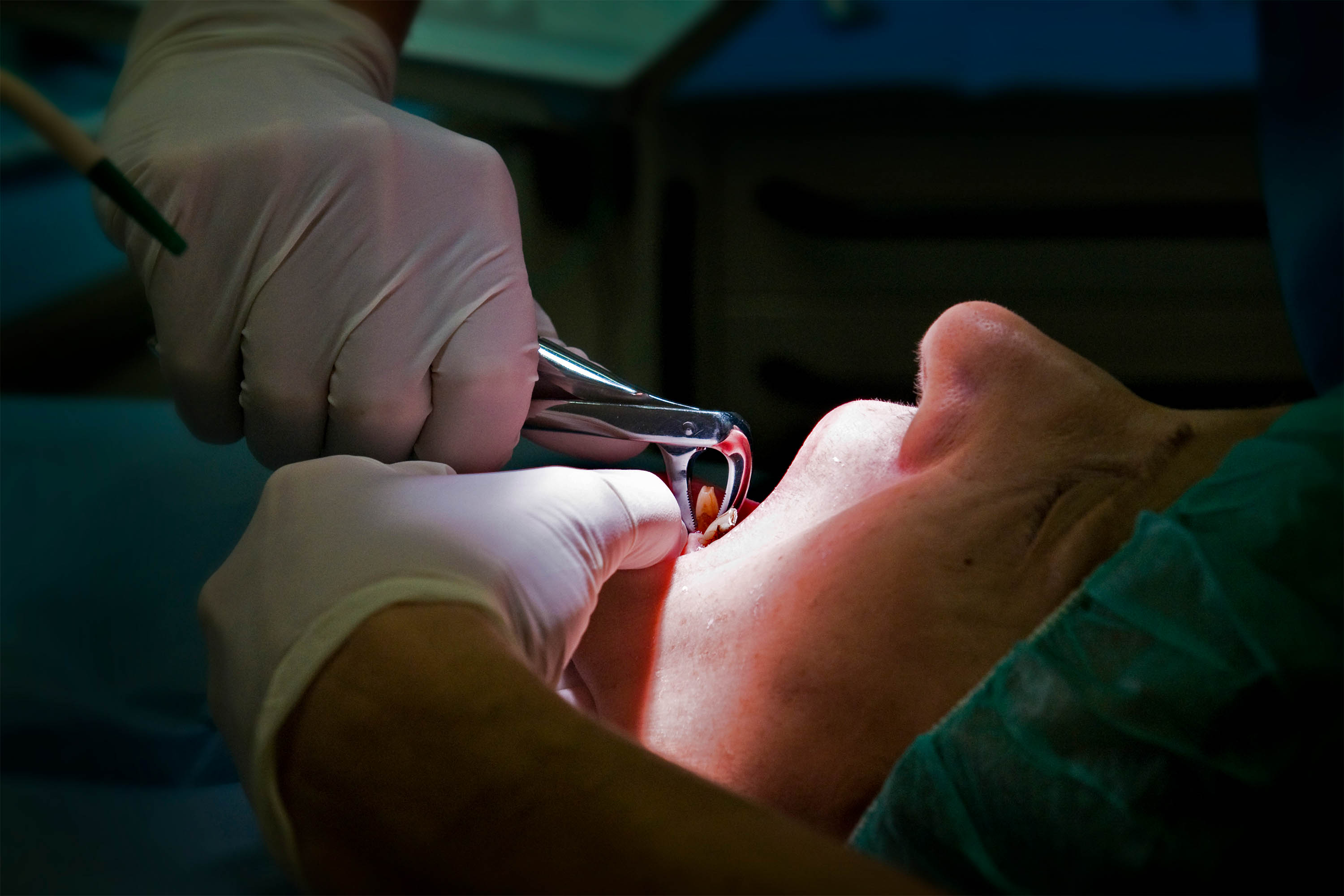 A photo of a tooth being extracted.