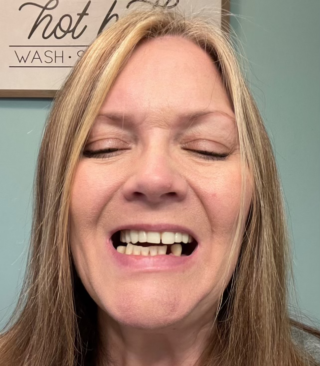 A photo of a woman showing her open mouth with dental implants and some misaligned bottom teeth.