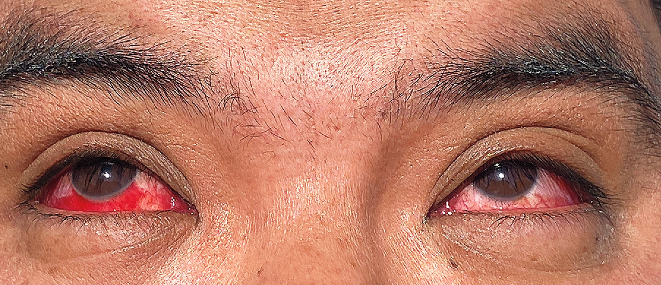 A photograph of the eyes of an infected dairy worker in Texas, with ruptured blood vessels and bleeding conjunctiva.