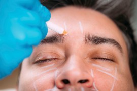 A close up photograph of a gloved hand making markings on a person's face in preparation for cosmetic surgery.