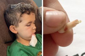 Two photos shown side by side: On the left, a young boy has a bloody gauze in his mouth. On the right, a hand holds an extracted tooth.