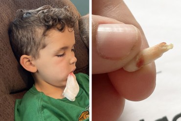 Two photos shown side by side: On the left, a young boy has a bloody gauze in his mouth. On the right, a hand holds an extracted tooth.