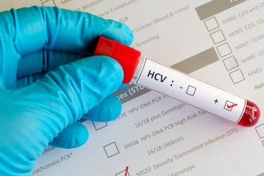 Blood sample with hepatitis C virus (HCV) positive