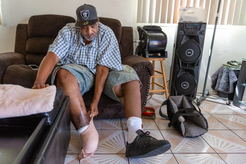 Diabetic Amputations A ‘Shameful Metric’ Of Inadequate Care