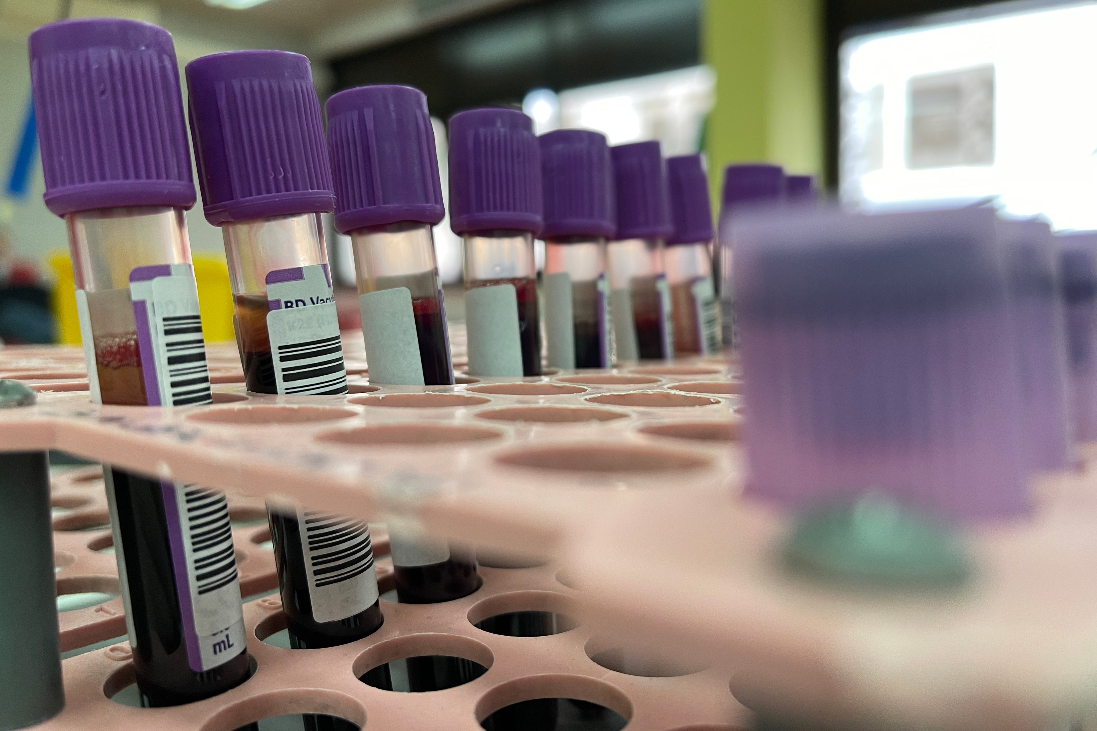 A photo shows vials of blood samples for testing for monkeypox virus.