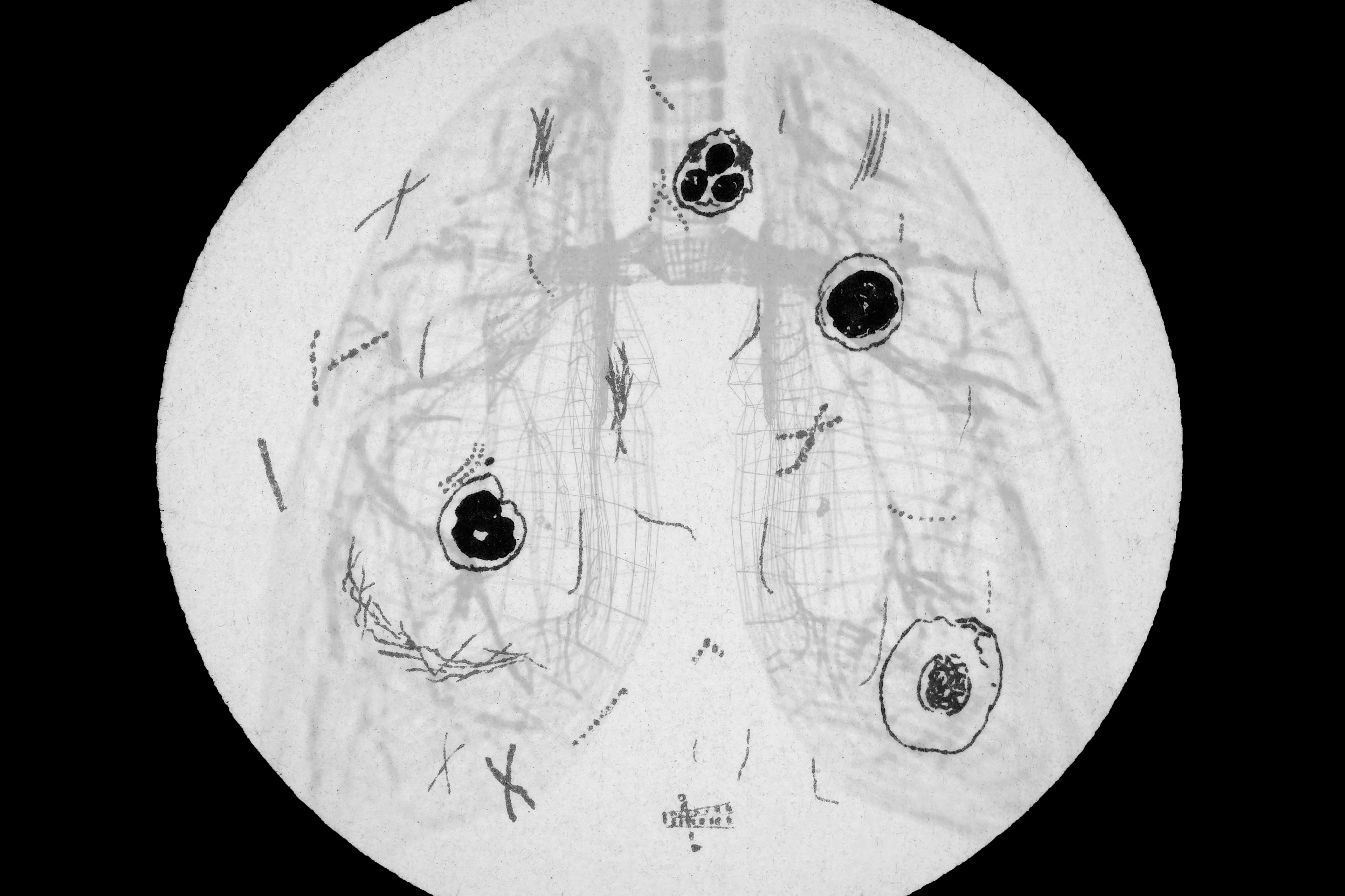 An illustration shows tuberculosis bacteria from a microscope overlayed on top of a diagram of lungs.
