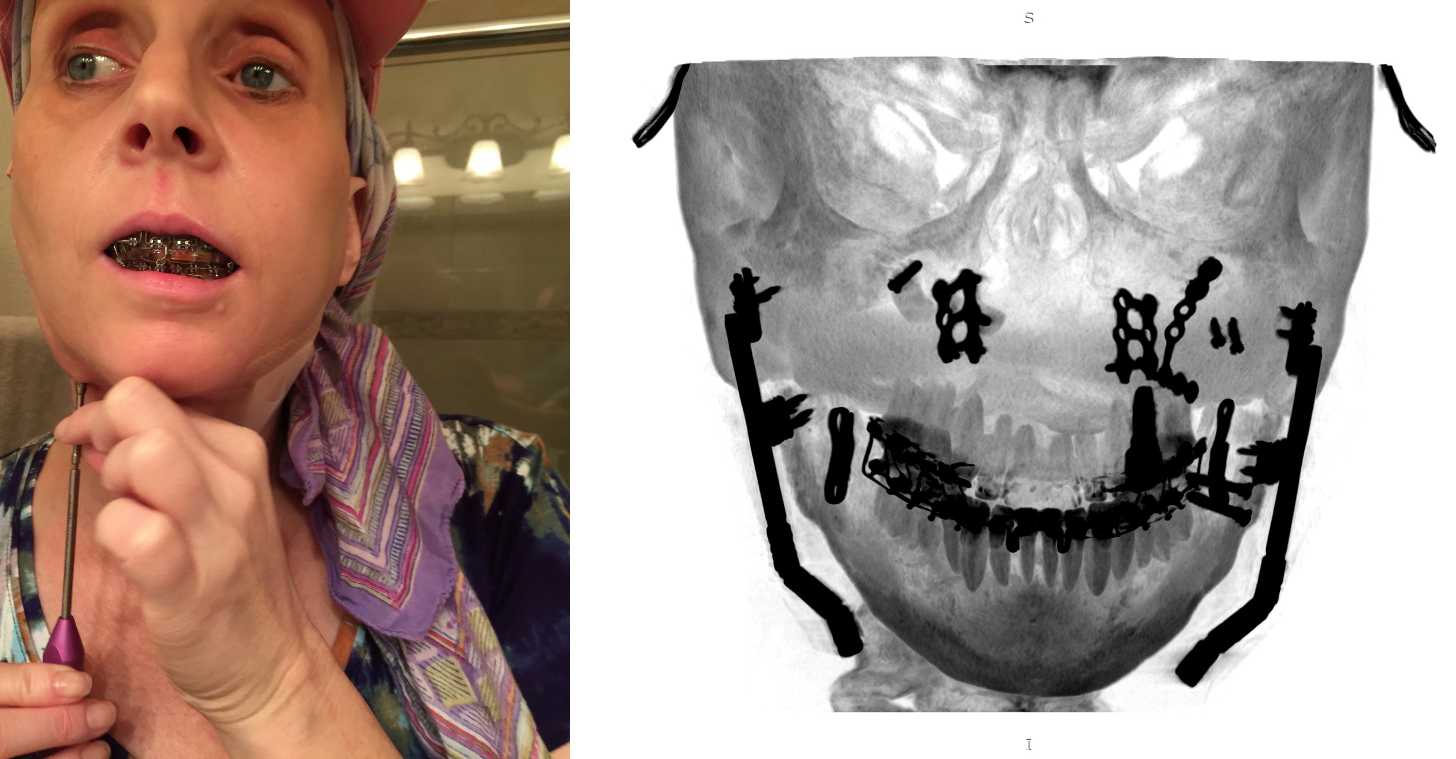 Two images are shown. On the left is a photo of a woman using a screwdriver to twist screws implanted in her jaw. On the right is a scan showing the screws inside her skull.