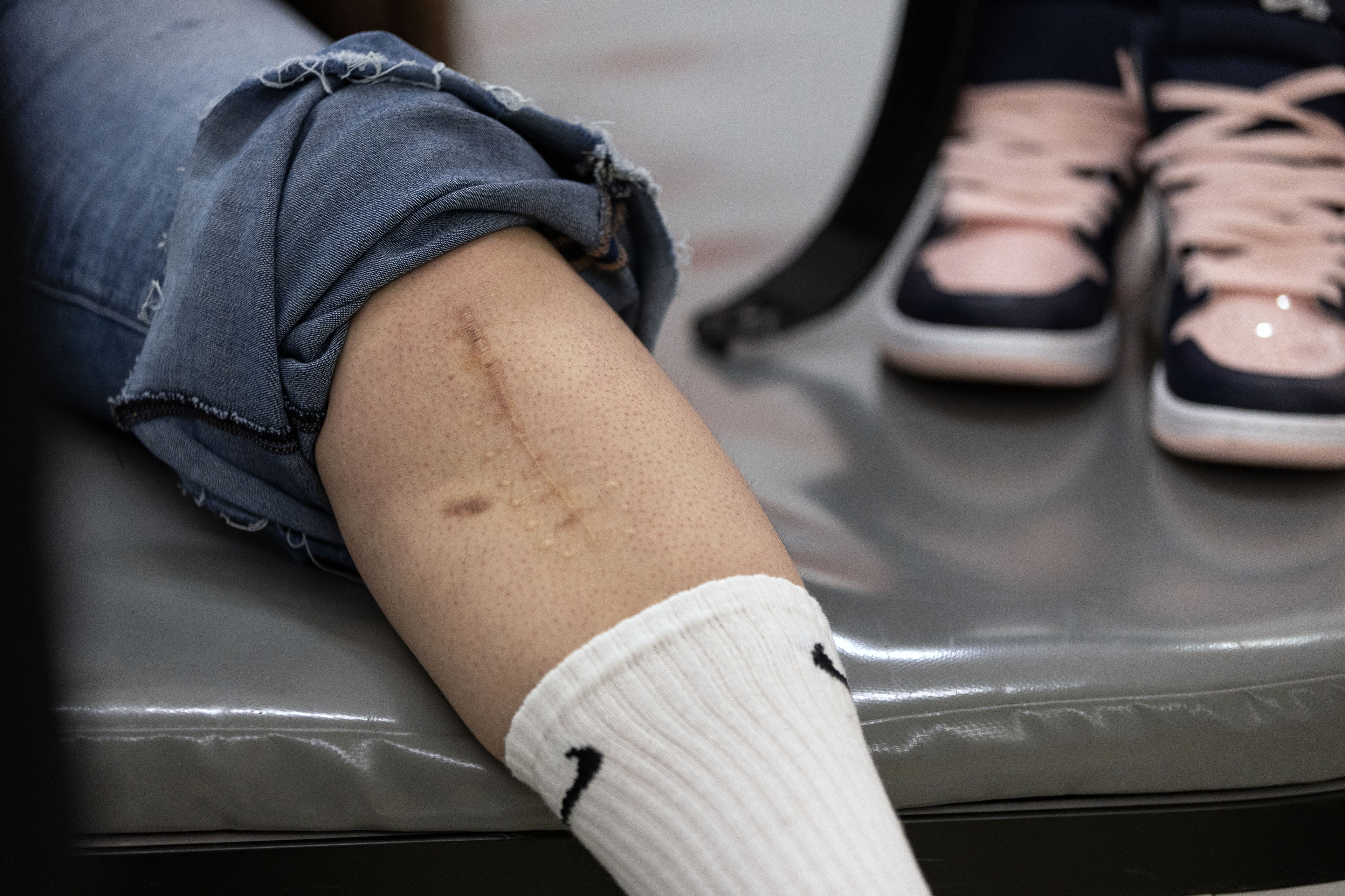 Portrait of a leg with denim jean pulled up and a scar visible