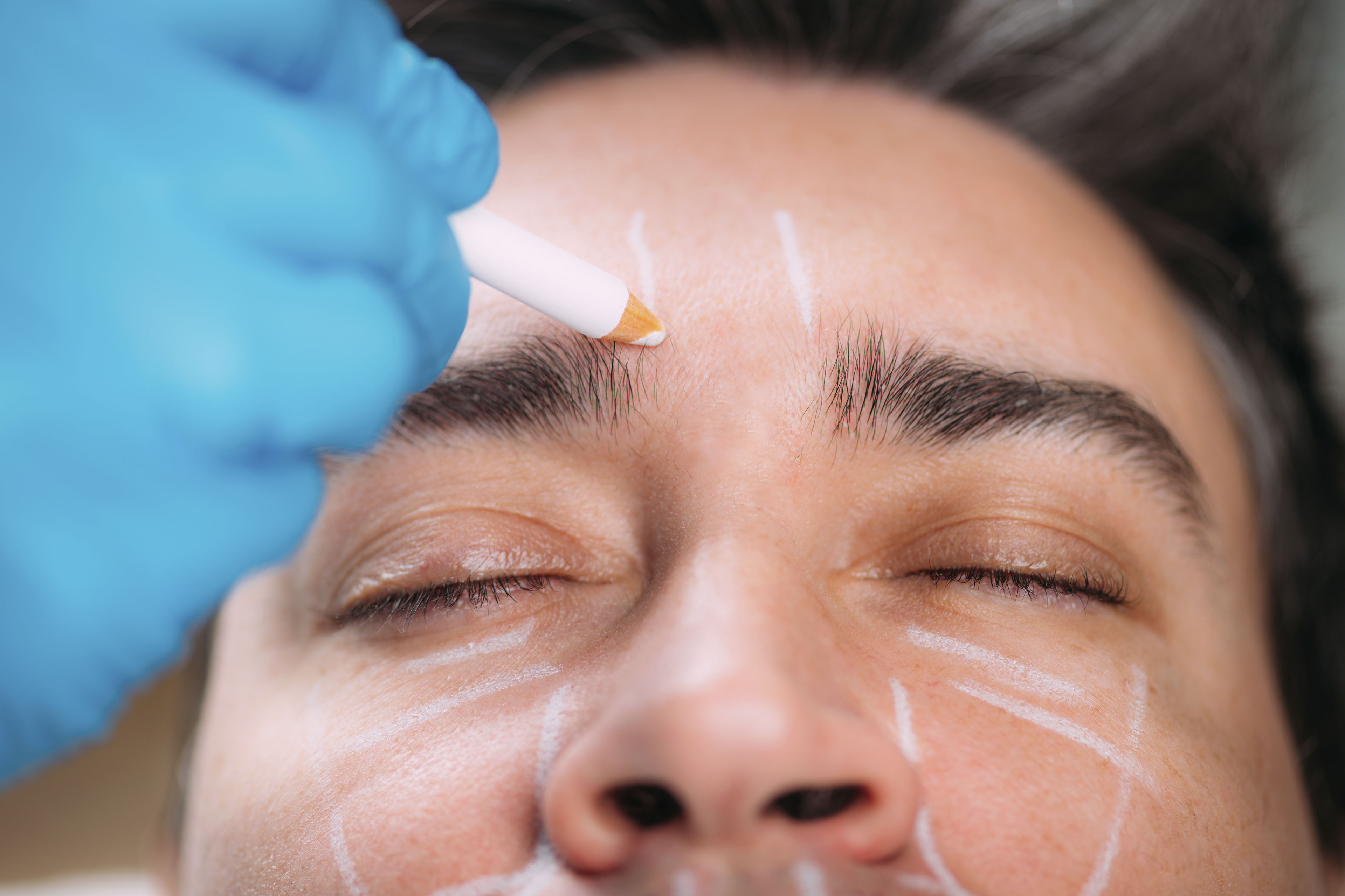 A close up photograph of a gloved hand making markings on a person's face in preparation for cosmetic surgery.