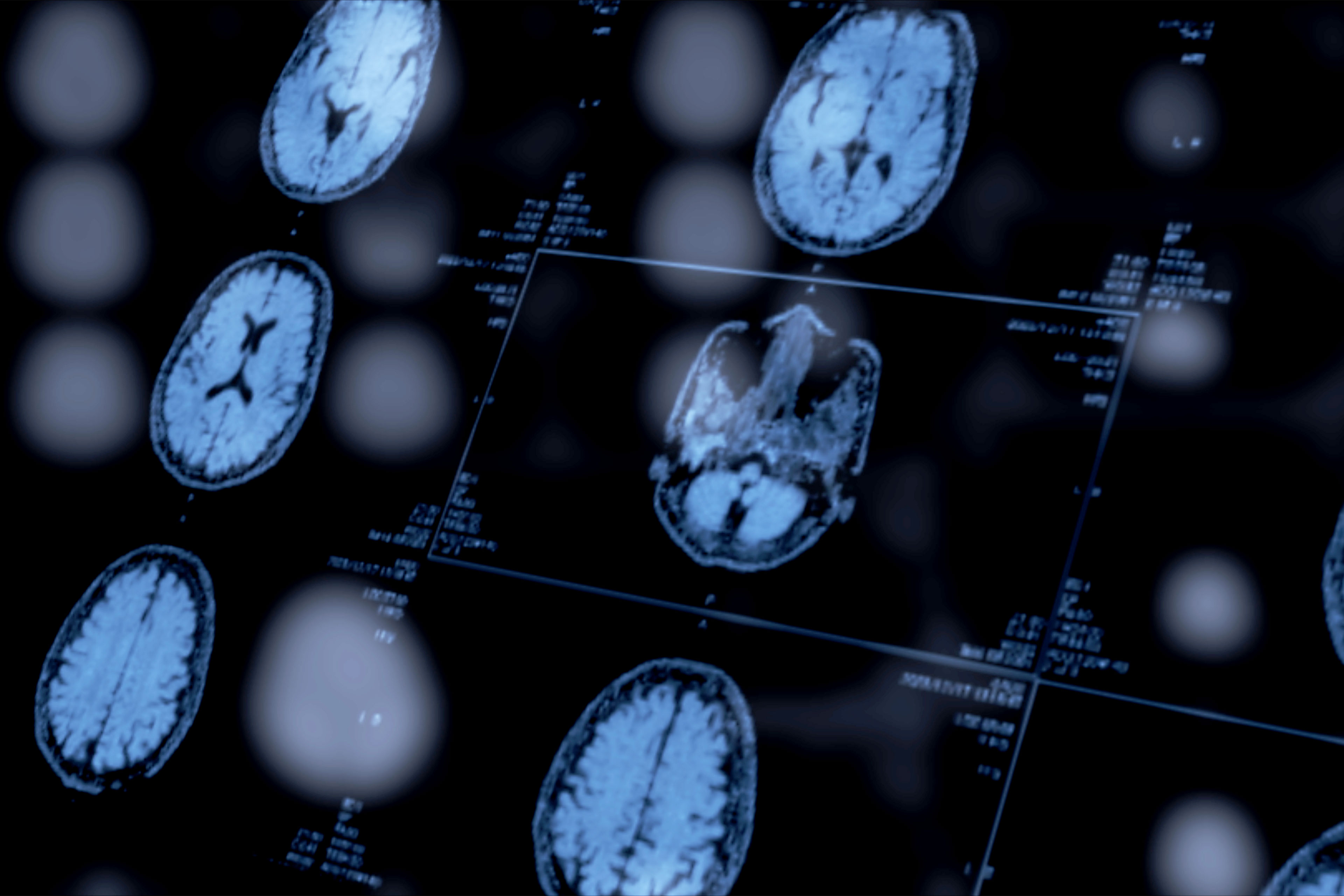 An image of several brain scans on a screen.